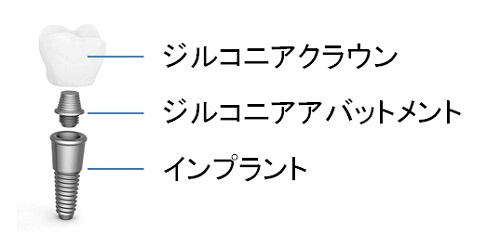 インプラント